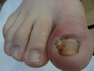 1甲沟炎 1甲沟炎